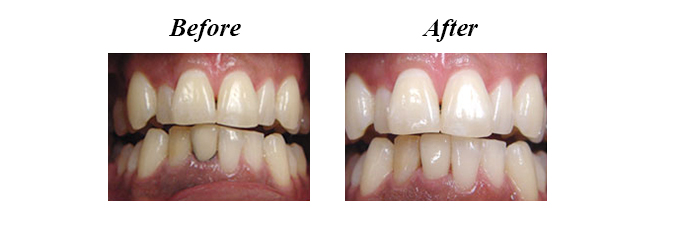 Restoration with Dental Crowns