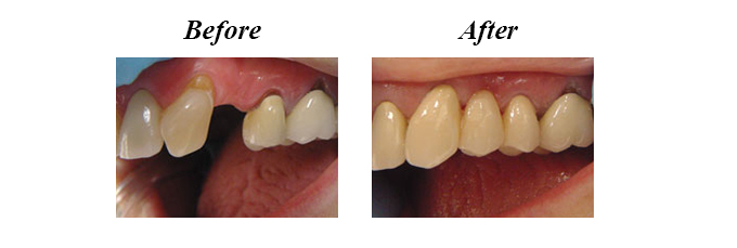 Dental Bridges Before and After