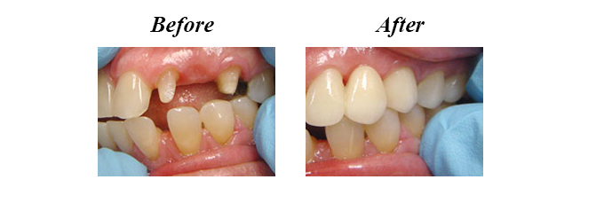 Before & After - Dental Bridges