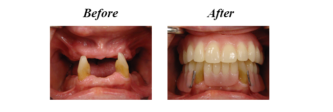 Dentures - Replacing Missing Teeth