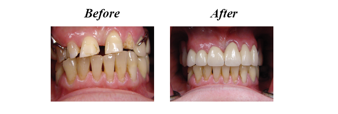 Partial Dentures to Replace Teeth